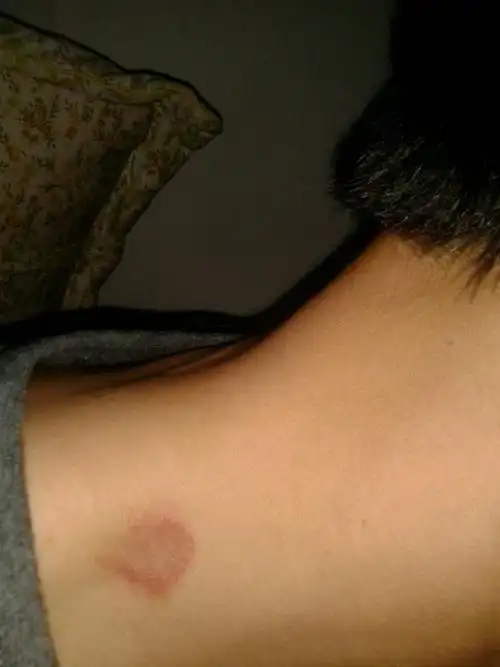 请问我脖子是什么皮藓?用什么药好?用达克宁没有效果.