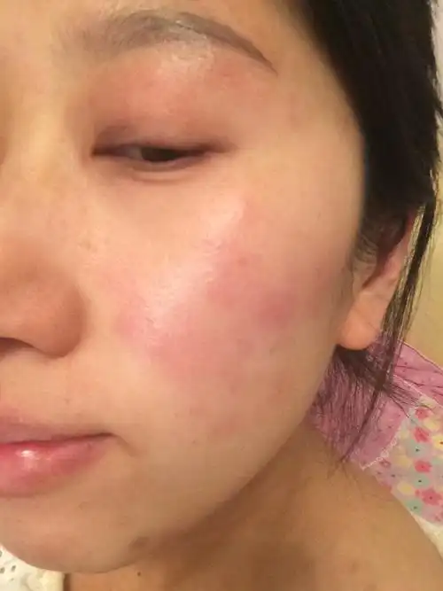 皮肤红痒,上次涂了皮炎平,里面还有水冒出,这是毒吗,反复发作好像是