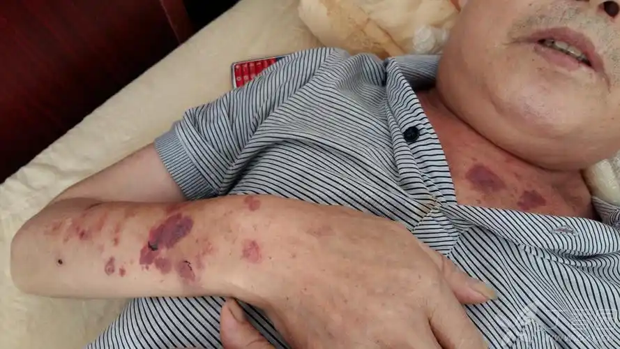 患者多发皮下紫色斑块1月 - 皮肤与性传播疾病讨论版 -丁香园论坛