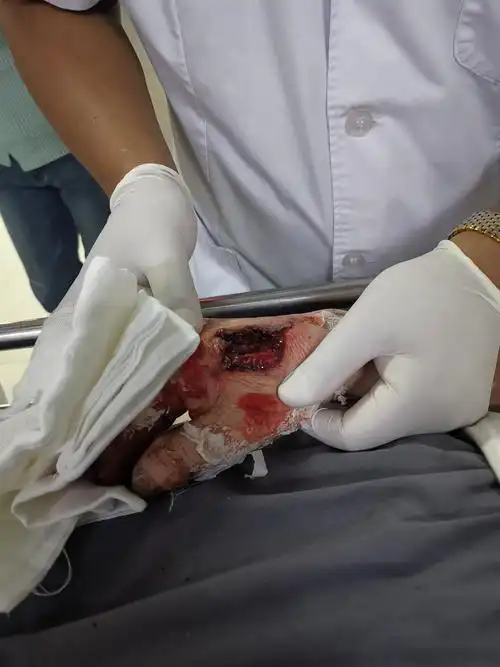 手背眼睛电砂轮伤 - 美篇