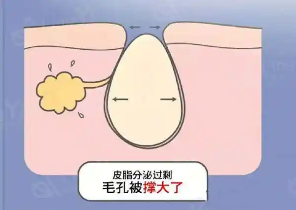 角质被堵塞导致毛孔粗大