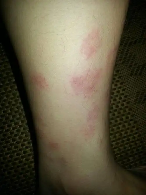 左小腿上长了好多红斑,一开始很小然后一天比一天大,最近还感觉有点痒