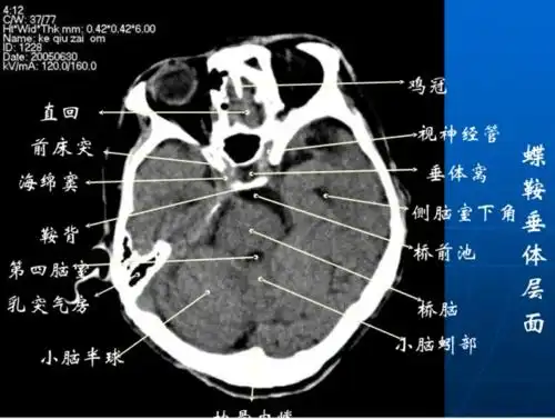 影像医生必须掌握的头颅ct解剖与常见出血梗死判读