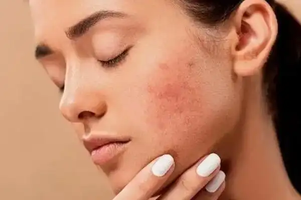 皮肤出油的表现皮肤出油的好处