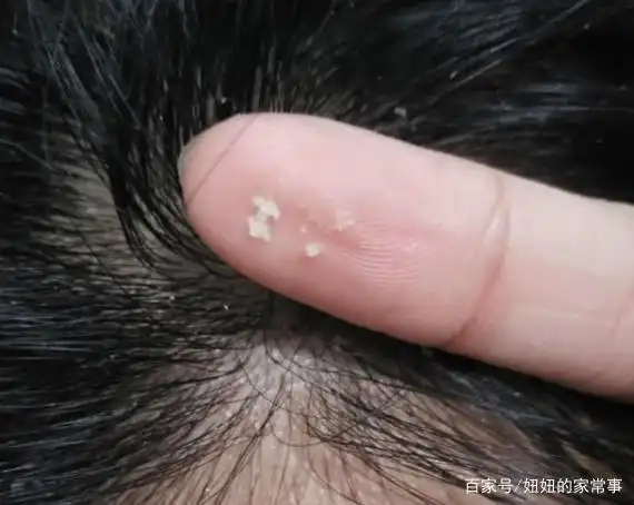 一个小妙招,头痒,头屑,头皮出油统统消失,螨虫不再来