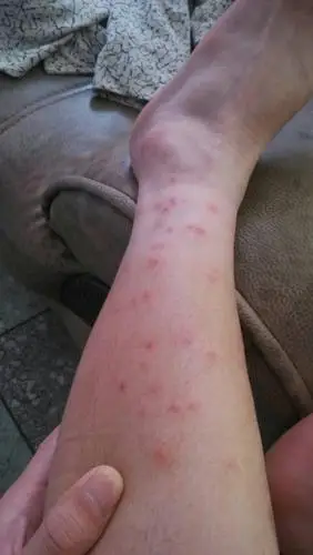 跳蚤,蜂等昆虫将口器刺入皮肤吸血,或者将毒汁注入人体引起的皮肤过敏