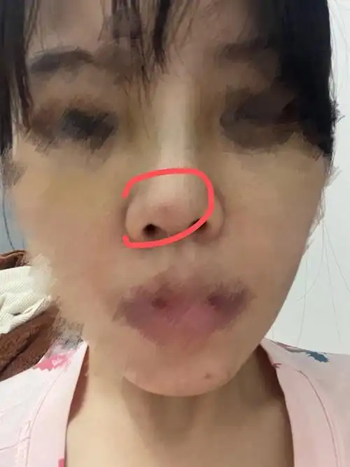 隆鼻天假体倾斜山根左侧鼓包求医生帮忙解答