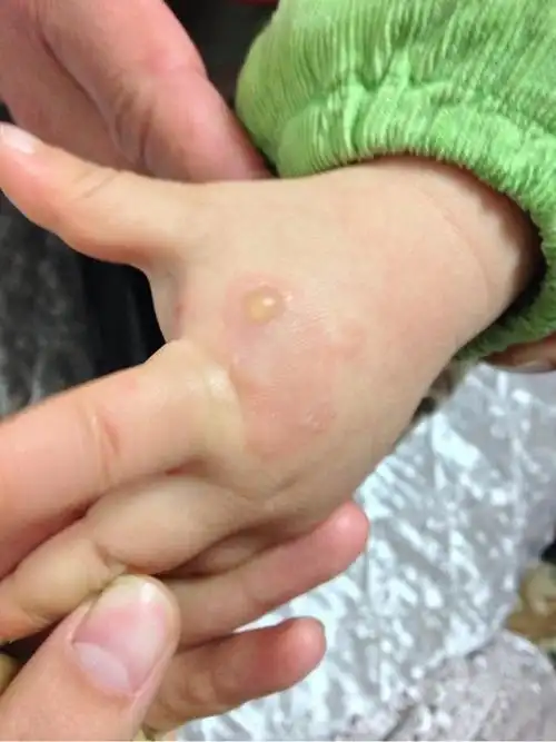 看监控被拒2岁孩子被幼师深度烫伤幼儿园已辞退