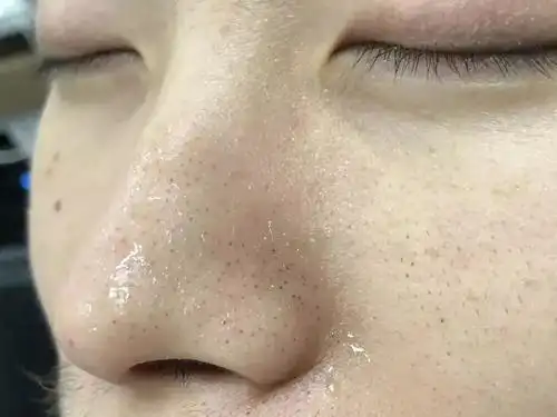 毛孔粗大还有黑头这不是要人命吗?难受该怎么办?