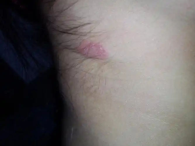 你好脖子后面起了一块红斑有时很痒不知道是不是银屑病我