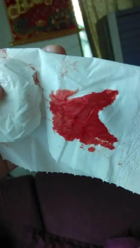 确切的说宫外孕出血是什么颜色32岁女子腹痛出血,确诊宫颈癌,医生