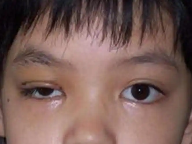 眼睛提肌无力图片