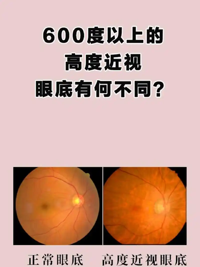 🙊没错,高度近视患者的镜片厚度比中低度近视的要厚不少,但高度