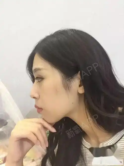 牙套150天侧面对比 忽略妆看嘴巴,虽然没怎么收但好像下巴核桃