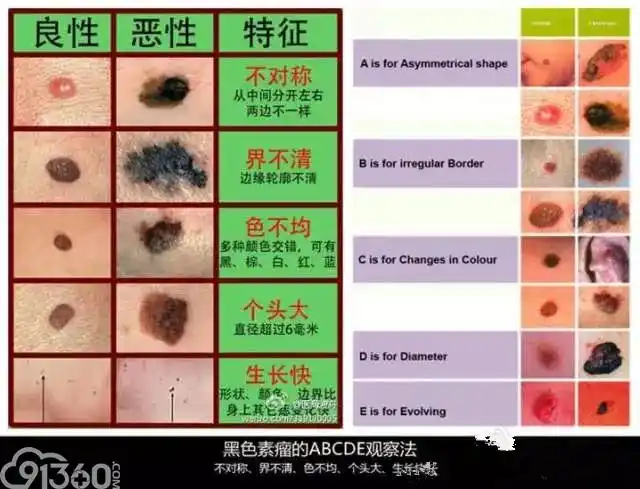 翻转课堂|黑色素瘤