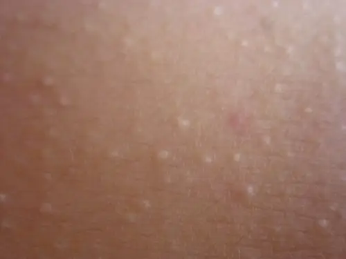 皮肤病麻烦帮看看这是栗丘疹还是汗管瘤