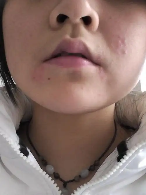 你好 请问 我嘴角老是长一些红红的颗粒不知道是什么 可能是疱疹