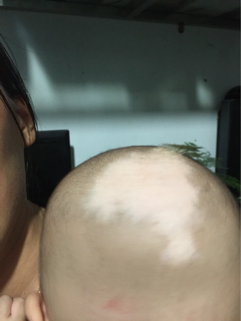 把头发剃了,长出来的还是白的,去医院检查了说是白癜风,怎么办呀!