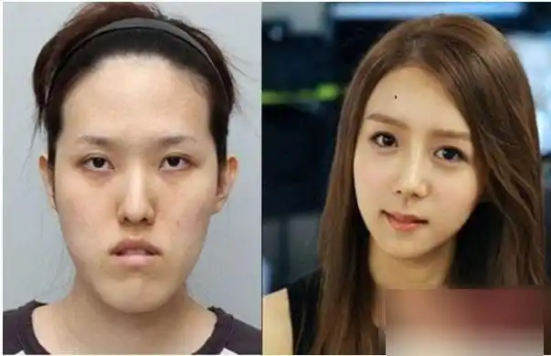 韩国整形医院实例流出 逆天对比照震惊网友(组图)