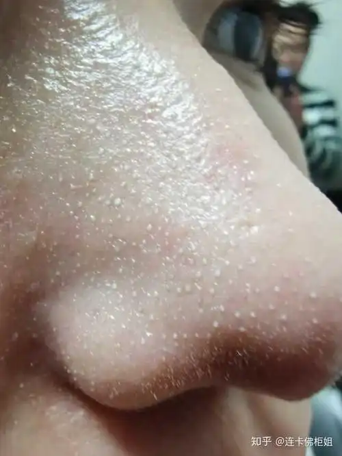 挤黑头应该如何处理留下的洞洞?