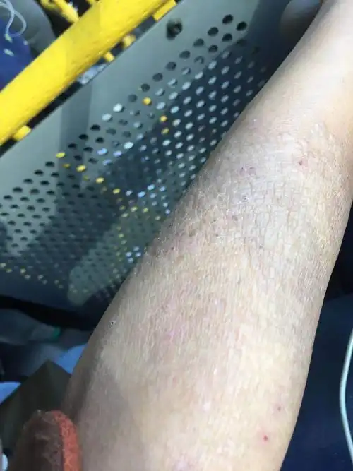 非药物治疗湿疹,神经性皮炎_湿疹_湿疹治疗方式 - 好大夫在线