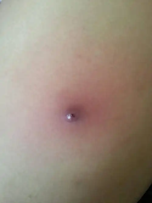 我老公的大腿内侧长了个这个,应该是火疖子吧,他挺疼的,有没有人知道