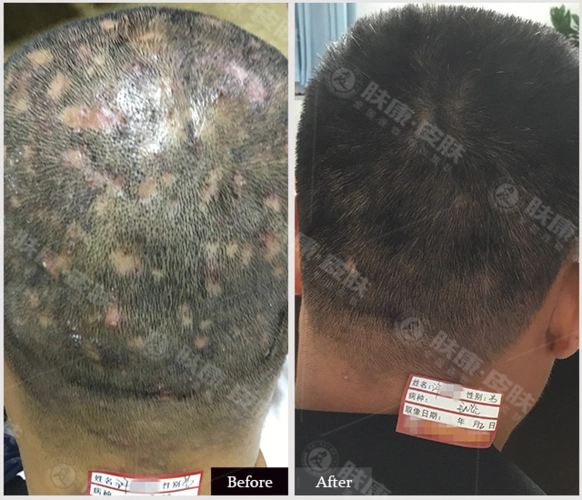 "毛囊炎"有多严重,你是真的知道吗?67治疗预防都要做好!_手机搜狐网