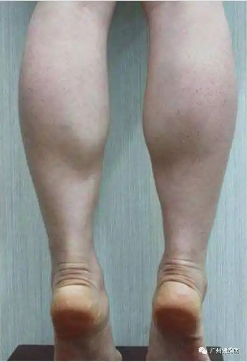 短跑健将博尔特,不仅肌肉发达腿也很细. 然鹅你的小腿是这样的