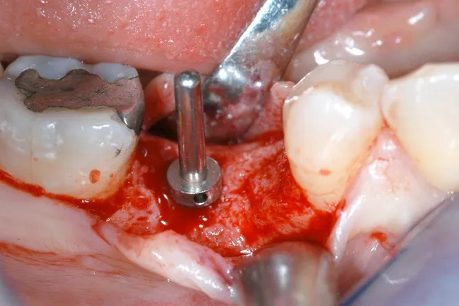 neoss下颌双侧第一磨牙缺失病例