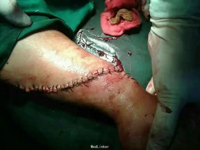 肌腱都断裂查体 辅查患者,男,31岁,缘于半小时前在劳作中不慎被电锯