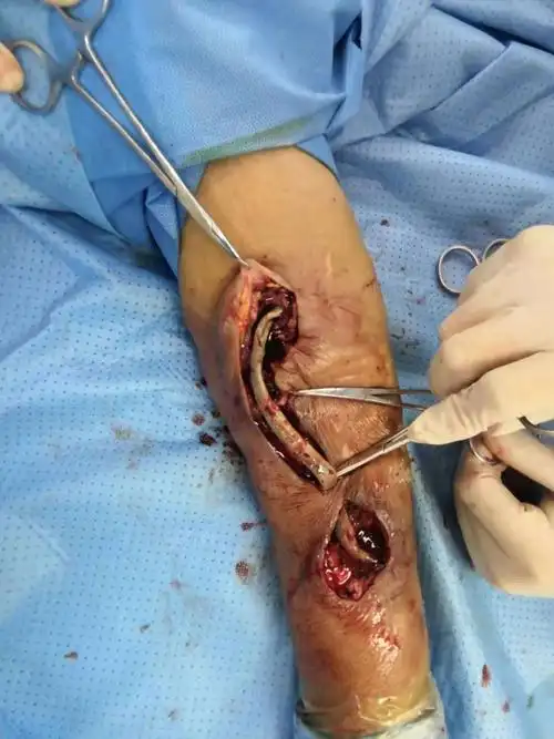 又一例定点穿刺avg惹的祸😱 - 美篇