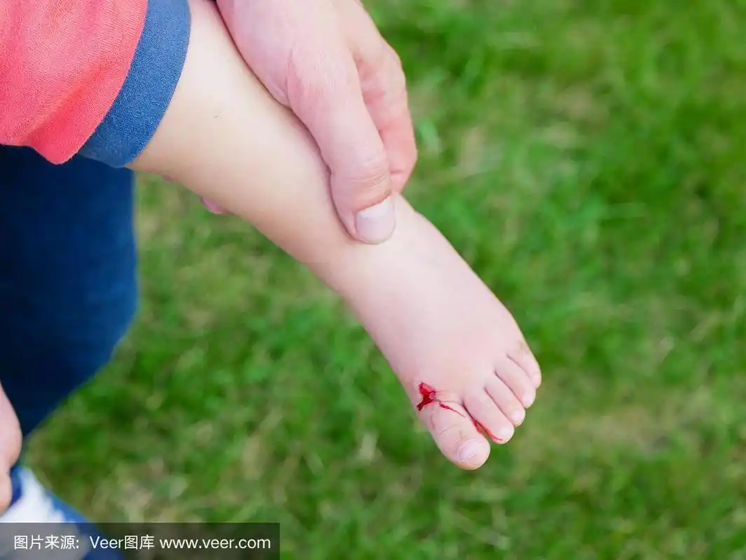 那个女孩伤了腿.腿上的伤口.受伤到流血.婴儿脚上的血