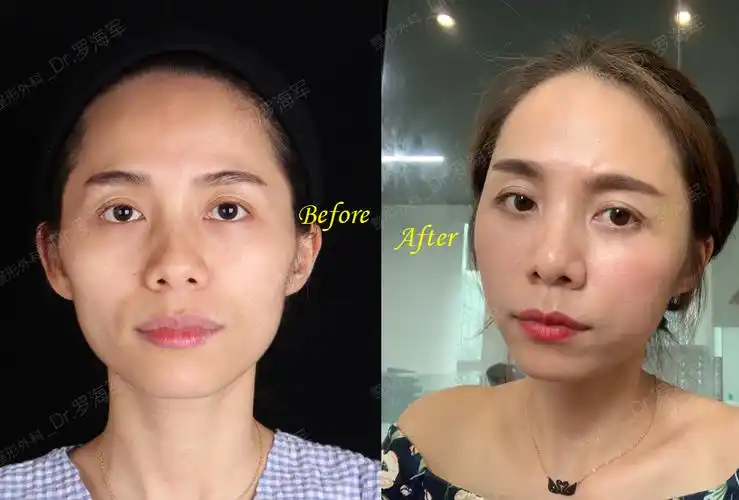 自体脂肪填充是否存在副作用