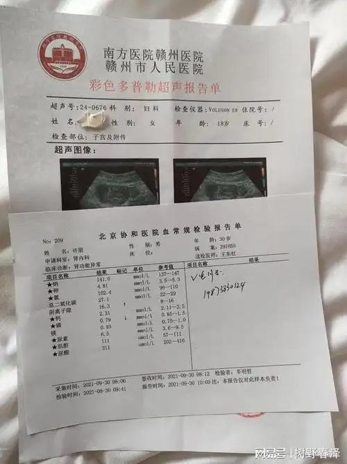 妇科检查白带为脓性或血性宫外孕的早期症状可能并不明显怀孕尿检