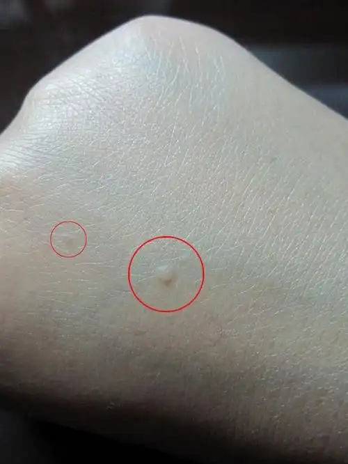 扁平疣属病毒性传染病,威力十足,治疗方法简单,治愈方便快捷