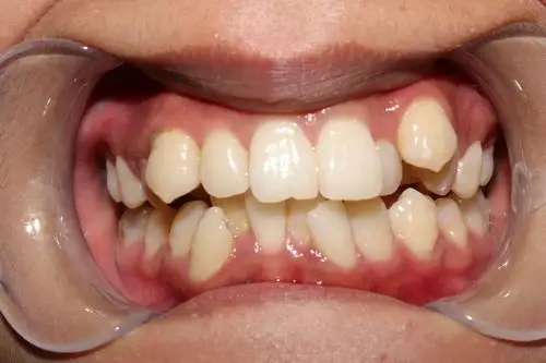 [cp]看照片你就知道拥有两排整齐的牙齿是多么重要_圈子-新氧美容整形