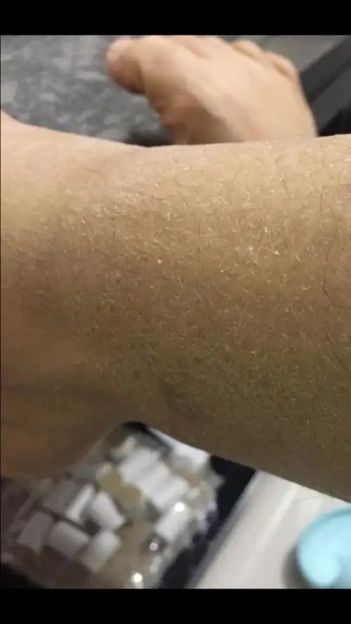 为什么我腿上的皮肤那么粗燥毛孔也很大,我才26岁呢