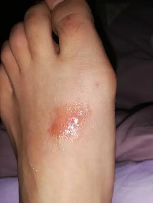 了红疹,也没空去看,就痒也就没管它,但是…好像渗出液体了…是湿疹吗