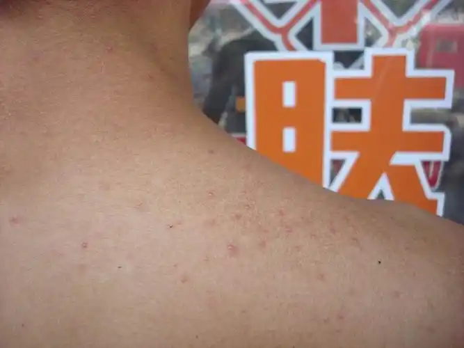 看图诊断糠秕孢子菌毛囊炎病例一例