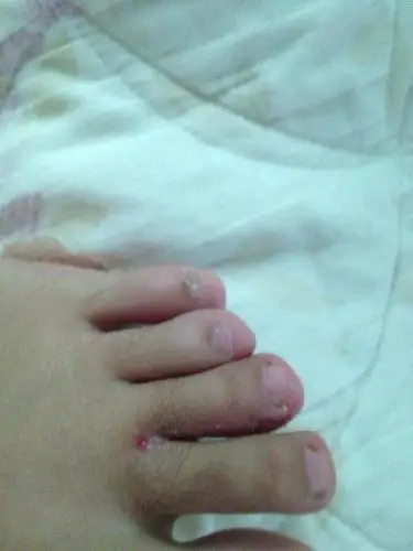 中脚趾间糜烂,脱皮,红痒已持续一个月左右时间,买了达克宁喷雾剂刺激