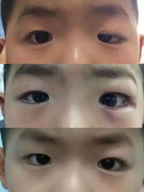 小朋友眼皮下垂该怎么改善?