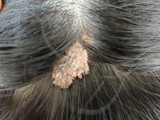 头皮上长的是什么