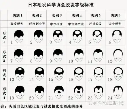 脂溢性脱发怎么办还能恢复生机吗