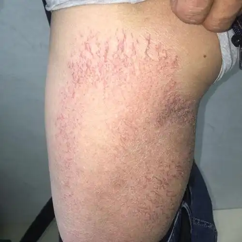 干性湿疹-石志坚副主任医师-爱问医生