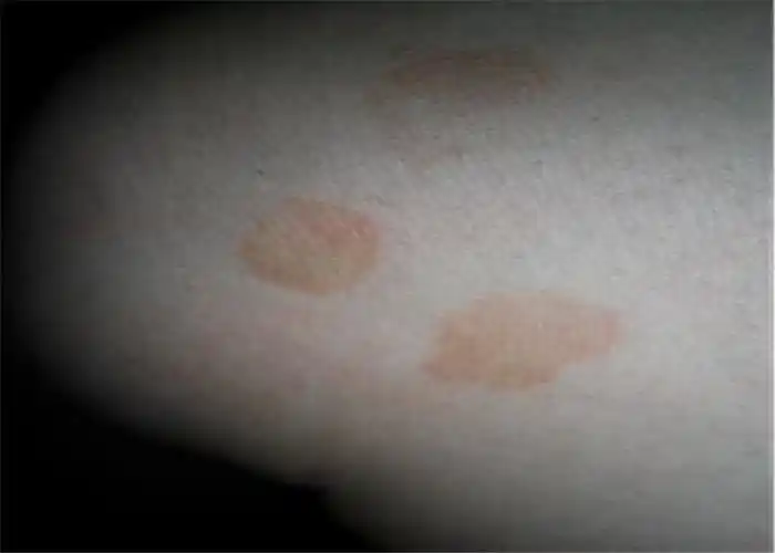 重庆花斑癣医院_重庆治疗花斑癣哪家医院好_重庆治疗花斑癣权威的医院