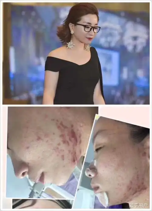 祛痘真的有那么难吗?