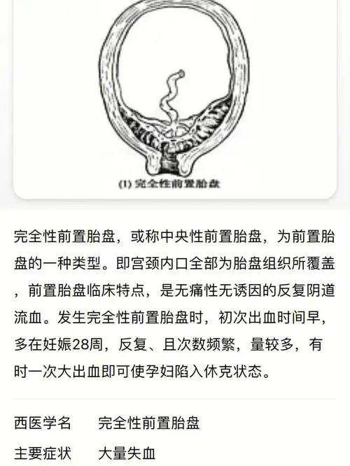中央性前置胎盘 脐带绕颈
