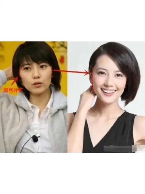 颧骨内推 #整牙能给颜值带来多大变化高圆圆:如何_圈子-新氧美容整形