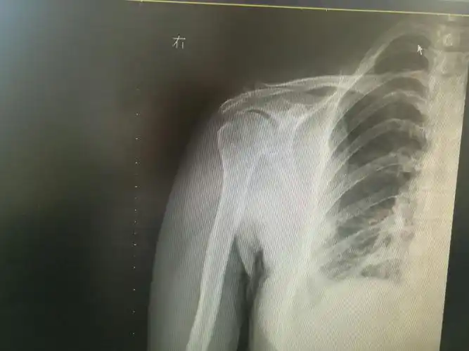 重视肩关节疼痛,认识肩袖损伤. 沭阳县人民关节外科