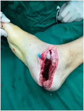 脚被电锯切到,差点掉了